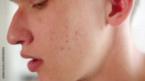 Boy with acne. Acne breakouts  on a young man’s cheek with skin texture blemishes. Men’s hand goes over his face with red inflammatory papules. Men’s skin care.