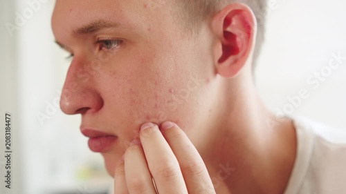 acne on a man's skin, skin texture blemishes. Men touching his face with red inflammatory papules. Men’s skin care.