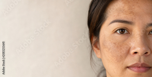 Woman with facial melasma and and hyperpigmentation, natural skin texture. For skincare, dermatology, beauty, and beauty awareness.