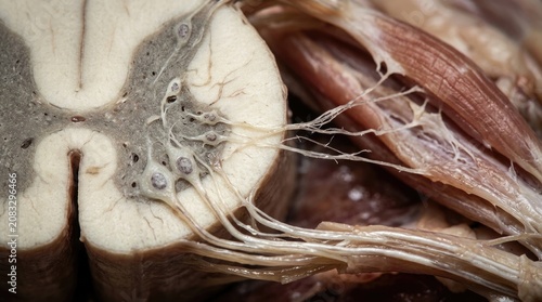Spinal muscular atrophy: motor neuron, nerve fiber, muscle tissue, anterior horn, genetic disorder, axon degeneration, cellular decay, neurological disease, somatic cell, anatomy detail.