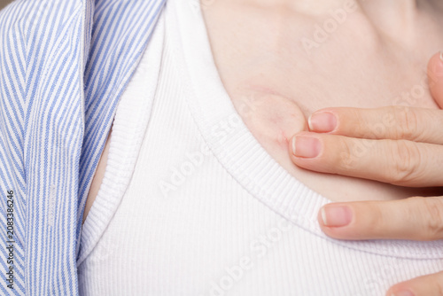 close-up of a woman's hand touching an implanted chest port, capturing self monitoring, sensitivity and routine body awareness during chemotherapy treatment