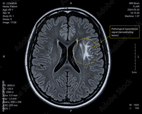 Brain MRI Scan with Highlighted Demyelinating Lesion, Diagnostic Medical Imaging, Neurology Concept