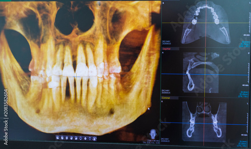 Foto Dental CBCT software interface featuring a 3D volumetric maxillofacial reconstruction alongside axial, sagittal, and coronal multi-planar slices