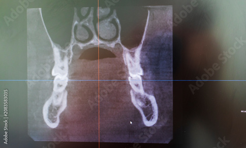 Dental CBCT software interface featuring a 3D volumetric maxillofacial reconstruction alongside axial, sagittal, and coronal multi-planar slices. dental