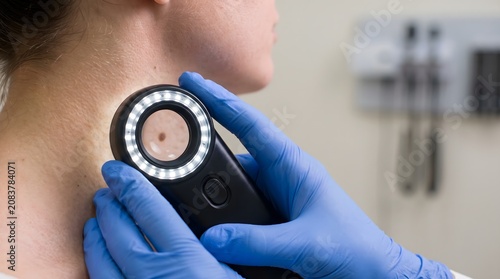 Dermatologist using dermatoscope to examine mole on neck for early detection of skin cancer.