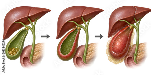 Cholecystitis progression from gallstone impaction medical illustration