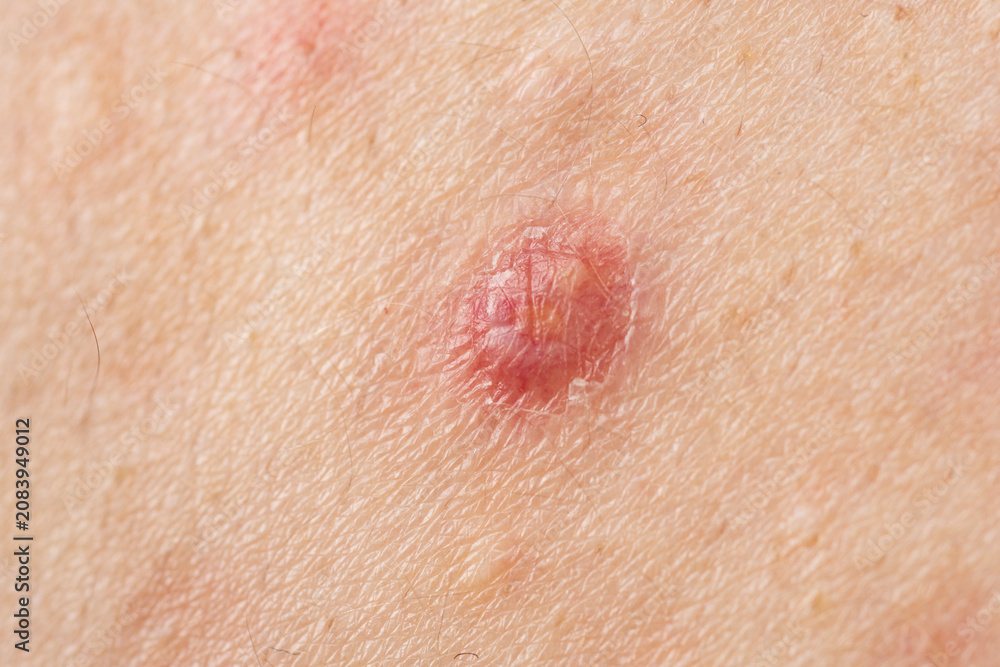 Fototapeta premium Acne with visible pores. Acne with inflamed pimple. Acne with skin blemishes. Acne around inflamed pustule.