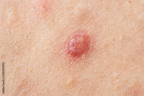 Obraz na plátně Acne with visible pores