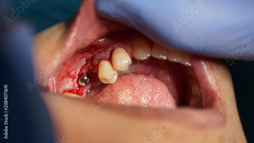 Obraz na plátně Close Up of Surgical Dental Procedure Inside Mouth With Exposed Gum and Missing