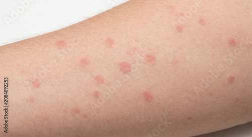 фотографія Rubella Macule - Macule in Human Skin — Medical Dermatology Plate (20-100)
