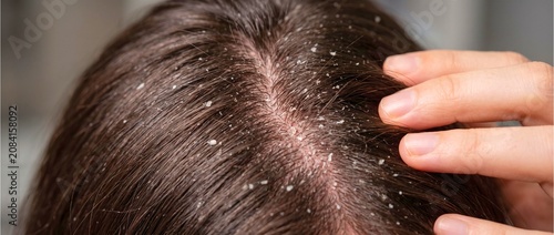 Detailed artwork showing parted hair, scalp covered with white flakes, and hand gently touching strands to reveal dandruff clearly