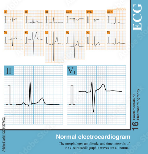 Male, 33 years old, healthy; the electrocardiogram from the medical examination was normal.
