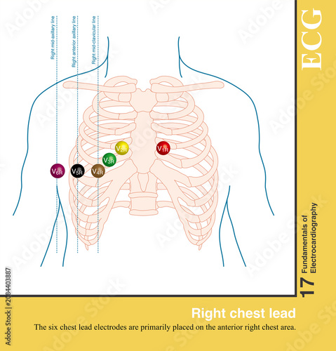 Right-sided chest leads involve placing six chest leads over the right anterior chest; lead V1 is positioned at the location of lead V2 from the standard six-lead chest configuration.
