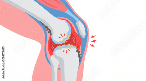 Photos Arthritis Joint Inflammation Illustration