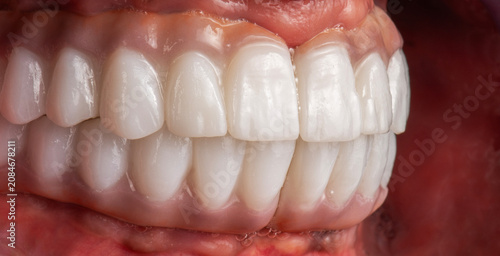 ceramic crowns and veneers