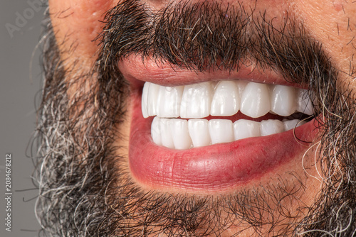 ceramic crowns and veneers