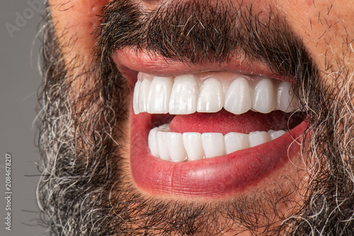 ceramic crowns and veneers