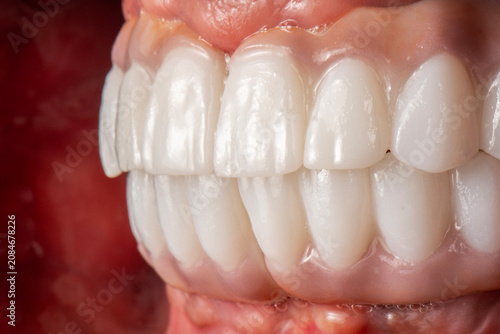ceramic crowns and veneers