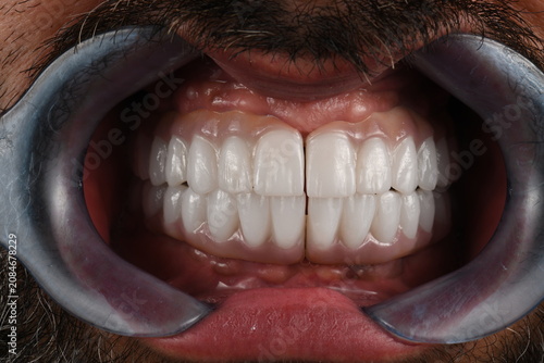 ceramic crowns and veneers