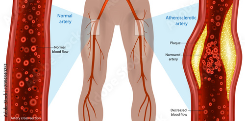 Peripheral Artery Disease Comparison with Normal and Atherosclerotic Femoral Artery Cross Section Medical Illustration. Plaque Formation and Reduced Blood Flow Anatomy Diagram