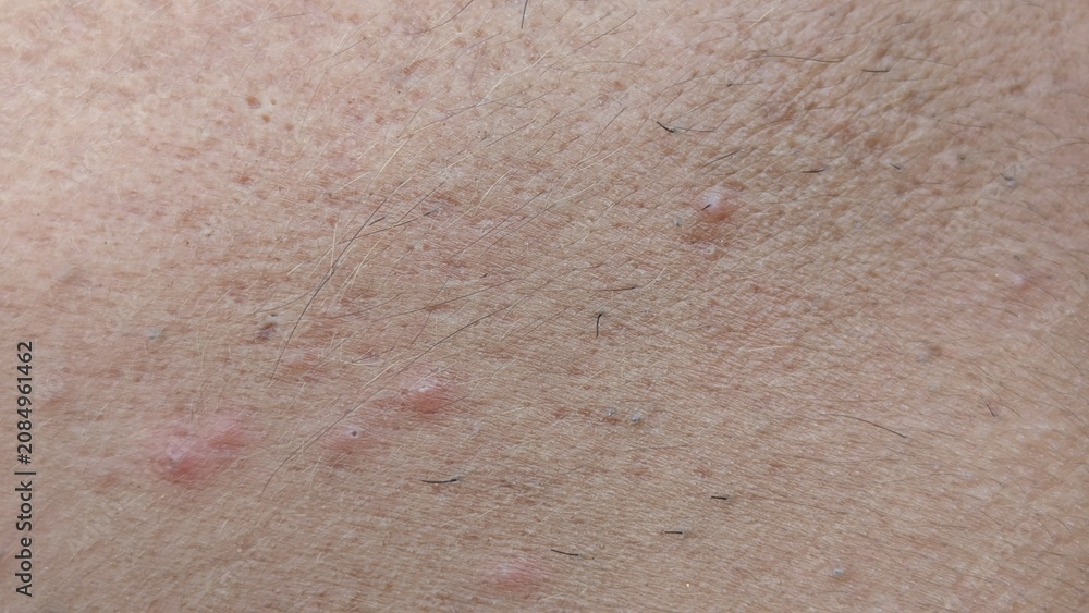 Fototapeta premium Extreme Close-Up of Human Skin Surface Showing Small Red Pimples Folliculitis and Body Hair for Dermatology