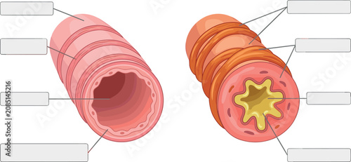 Quadro su tela Human Bronchi Cross Section Normal and Asthmatic Airway Diagram with Blank Text