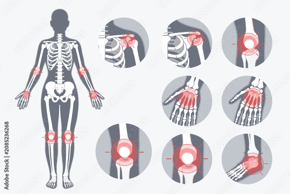 Fototapeta premium Diagram of a human body with highlighted red circles on joints indicating arthritis, chronic pain, or inflammation for medical use.