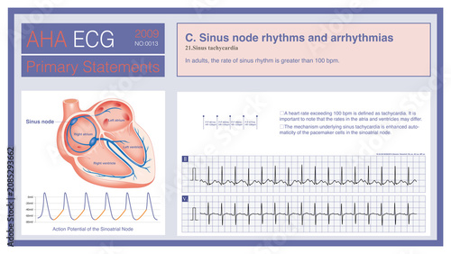 Photos Sinus tachycardia is defined as a sinus rhythm with a rate exceeding 100 beats per minute