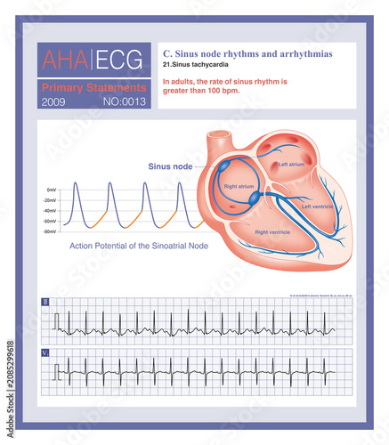Tableau sur toile Sinus tachycardia is defined as a sinus rhythm with a rate exceeding 100 beats per minute