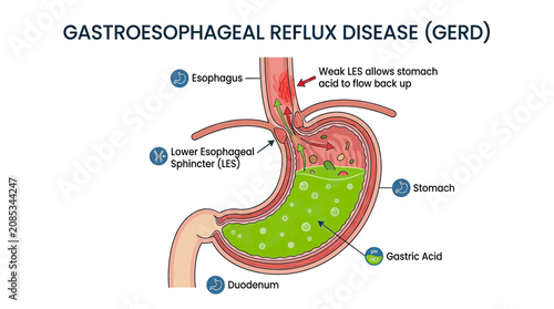 Schilderij op canvas GERD - Gastroesophageal Reflux Disease Anatomical Diagram of Stomach and Esophag