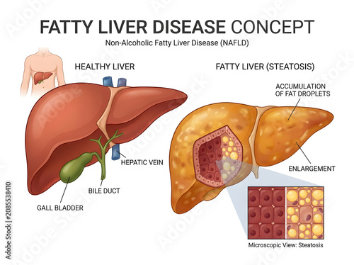 Healthy vs fatty liver disease comparison illustration