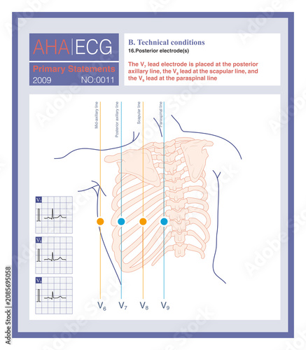 Posterior wall leads are three chest leads—comprising leads V7, V8, and V9—placed on the left side of the back to detect myocardial ischemia of the posterior wall.
