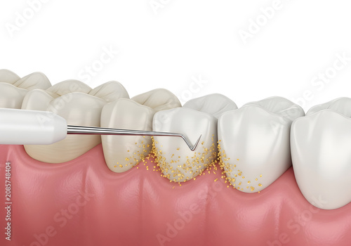 Dental scaling procedure with ultrasonic tool removing yellow plaque and tartar from human teeth for hygiene