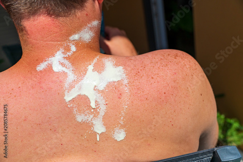 Foto Close-up of sunburned shoulders covered with soothing after-sun lotion following prolonged sun exposure