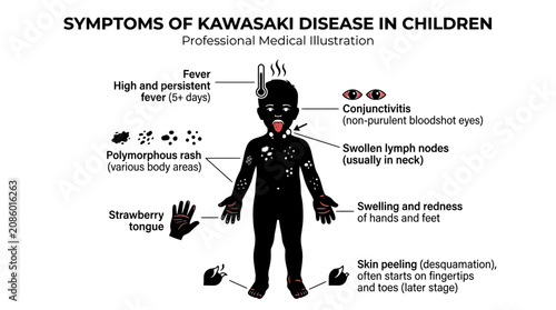 Fotografia Kawasaki Disease Symptoms in Children: Medical Illustration