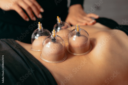 A therapist performs cupping therapy using vacuum suction on a person's abdomen. This method is part of a manual therapy treatment aimed at relaxation and muscle relief