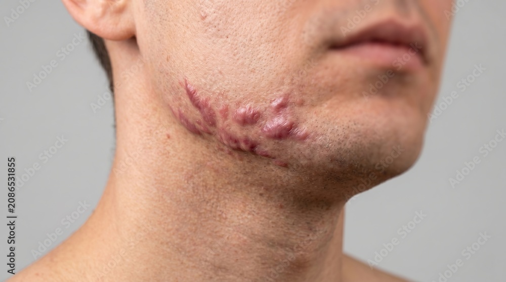 Naklejka premium Side profile of young man jawline with hypertrophic keloid scars from severe acne