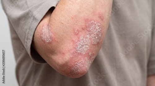 Close-up of red scaly skin patches on a human elbow showing symptoms of psoriasis