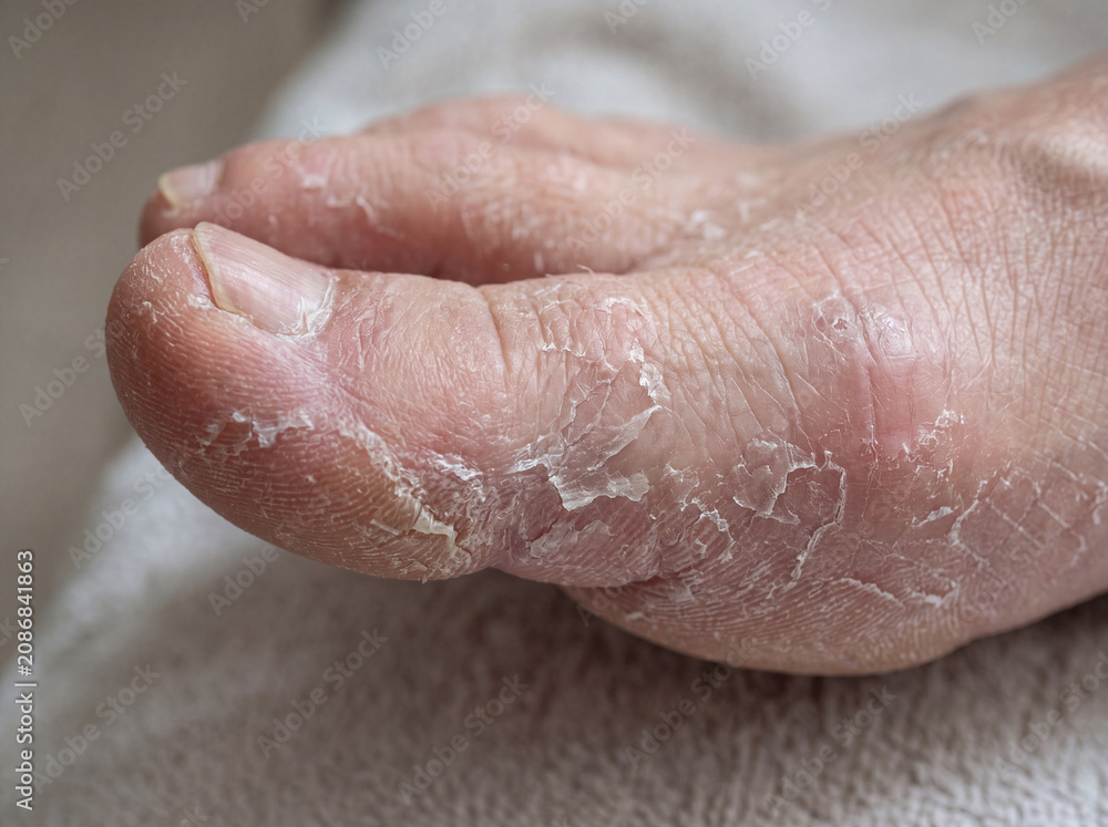 Fototapeta premium This close up shows dry and flaky skin on a human foot. The focus is on the toes and the surface of the skin. It appears rough and cracked. This could relate to podiatry or skin care