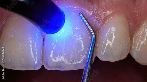 Macro close up of a blue dental curing light and metal explorer during a composite resin restoration on human anterior teeth