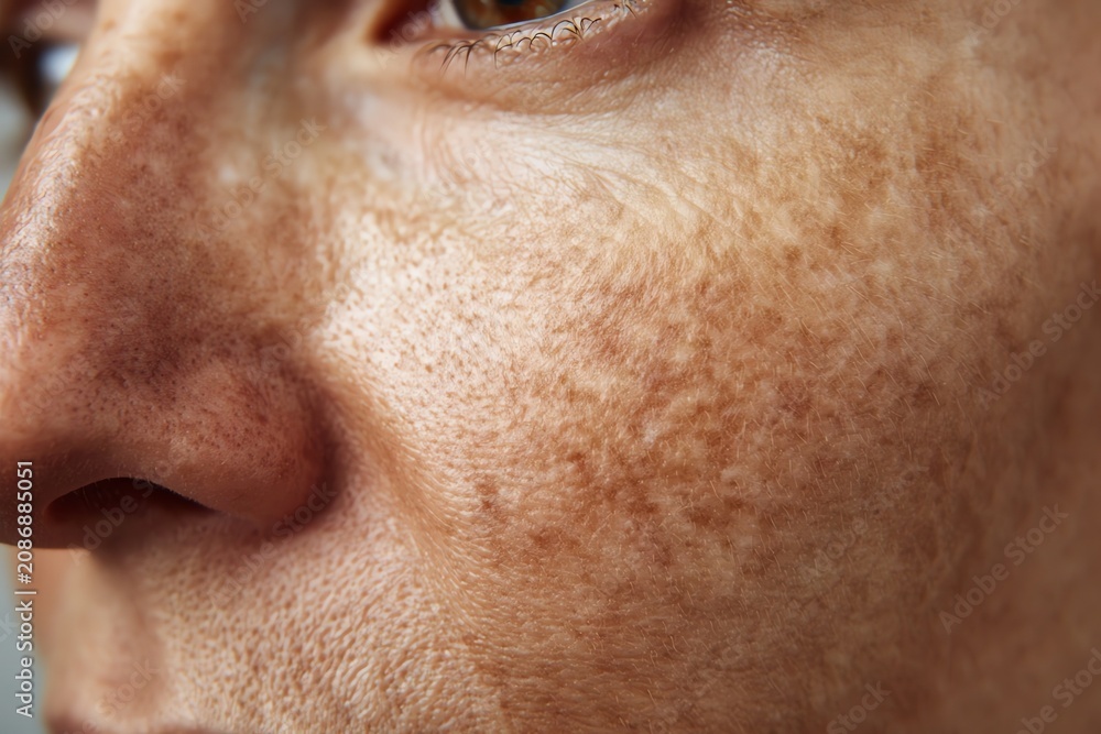 Naklejka premium Facial Hyperpigmentation Close Up with Irregular Dark Patches and Visi