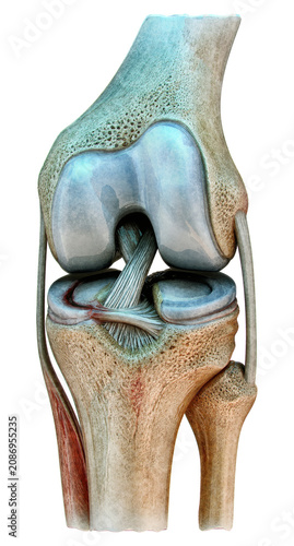 Meniscus tear anatomy, knee joint injury, orthopedic medicine. Human knee anatomical cross section: torn medial meniscus, cruciate ligaments, cartilage. Traumatology, sports injury, orthopedic surgery