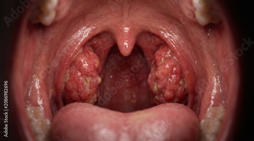 Inflamed Tonsils in Human Throat