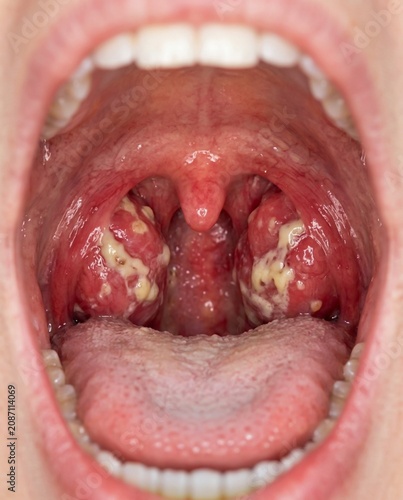 Severe acute tonsillitis with white exudate