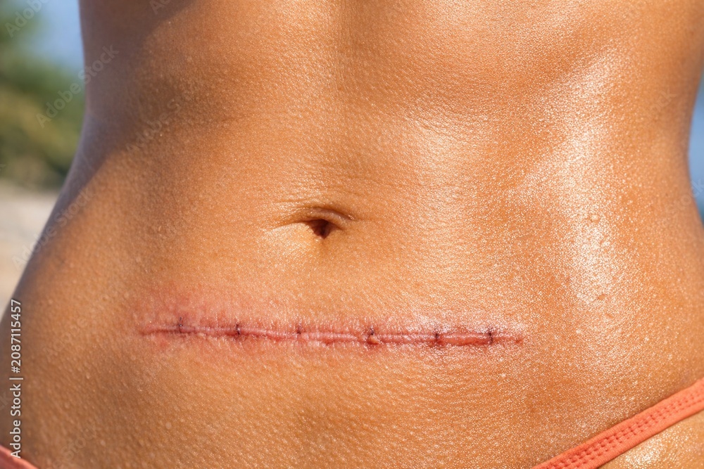 Fototapeta premium A close-up view of an abdominal wound, often seen in medical or emergency situations