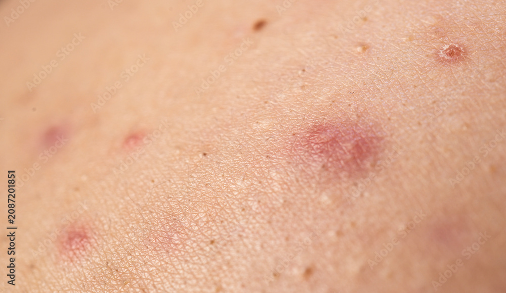 Fototapeta premium Acne skin pimple. Skin problem with acne bumps. Irritated Acne texture. Close up Acne issue.