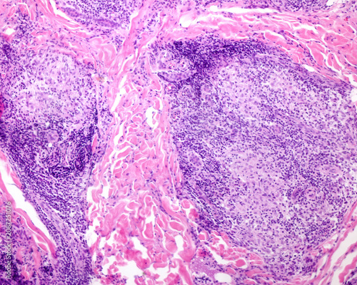 Photography Human skin. Leprosy