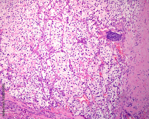 Renal cell carcinoma