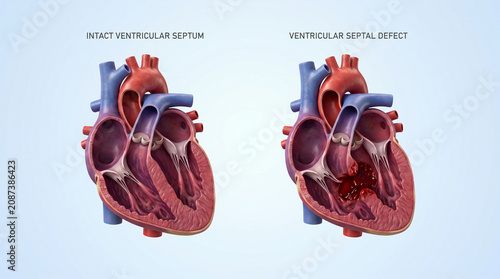 3D Illustration of Intact Ventricular Septum vs Ventricular Septal Defect
