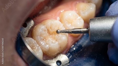 Closeup dental restoration preparation with rotary bur on molar under rubber dam